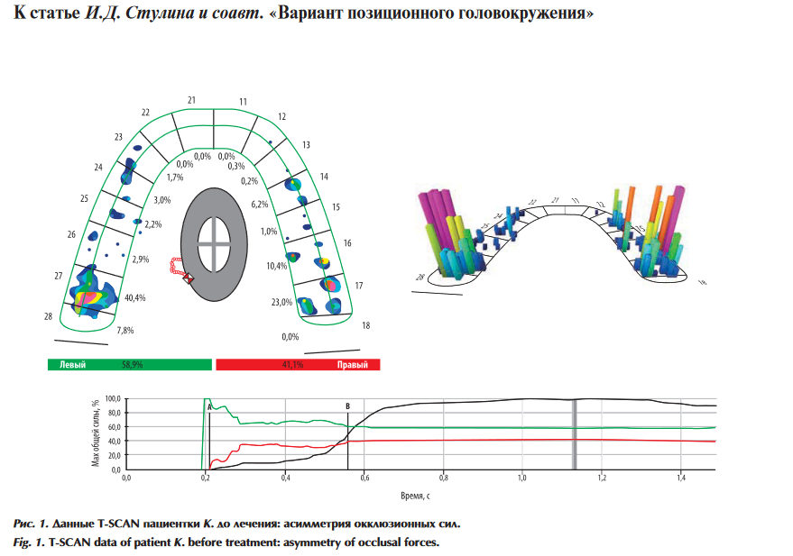 Рисунок 1. Данные T-SCAN до лечения: асимметрия окклюзионных сил