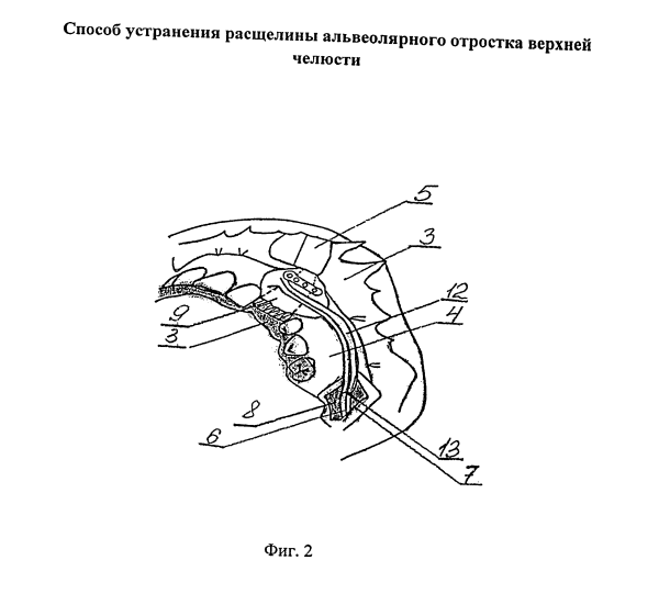 Фигура 2. Схема из патента RU 2668807 C1; обозначения расшифрованы в описании изобретения