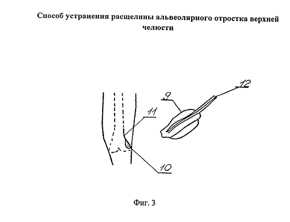 Фигура 3. Схема из патента RU 2668807 C1; обозначения расшифрованы в описании изобретения