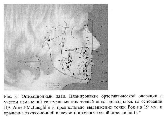 Рис. 6. Операционный план. Планирование ортогнатической операции с учетом изменений контуров мягких тканей лица проводилось на основании ЦА Arnett-McLaughlin и предполагало выдвижение точки Pog на 19 мм и вращение окклюзионной плоскости против часовой стрелки на 14°.