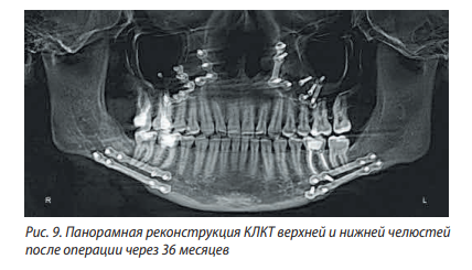 Рисунок 9. Панорамная реконструкция КЛКТ верхней и нижней челюстей после операции через 36 месяцев