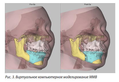 Рисунок 3. Виртуальное компьютерное моделирование ММВ