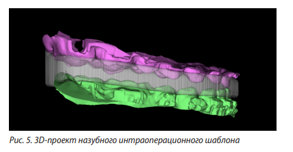 Рисунок 5. 3D-проект назубного интраоперационного шаблона