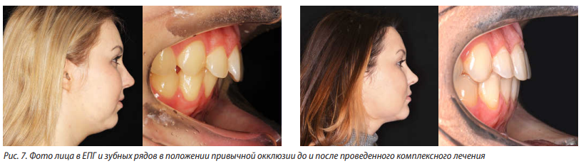 Рисунок 7. Фото лица в ЕПГ и зубных рядов в положении привычной окклюзии до и после проведенного комплексного лечения