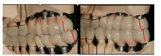 Рисунок 9 к статье об остеотомии Le Fort I перед протезированием; полная подпись ниже