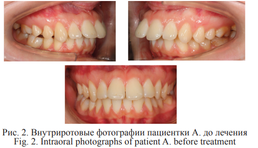 Рисунок 2. Внутриротовые фотографии пациентки А. до лечения