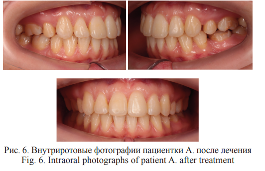 Рисунок 6. Внутриротовые фотографии пациентки А. после лечения