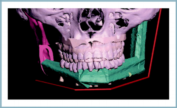 Рисунок 2: результат 3D-планирования реконструкции нижней челюсти.