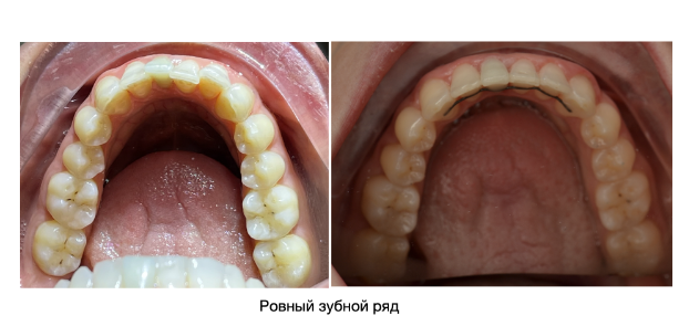 f12 n