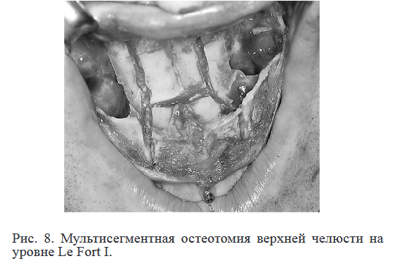 Рис. 8. Мультисегментная остеотомия верхней челюсти на уровне Le Fort I.